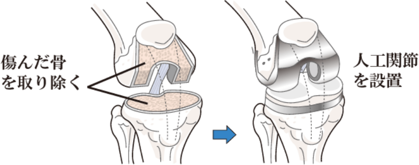 人工膝関節全置換術図